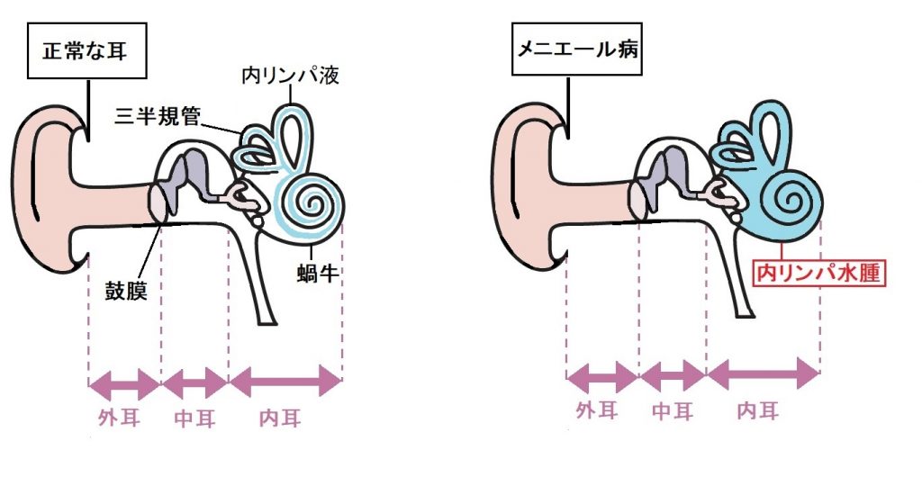 は メニエール 病 と めまいとメニエール病