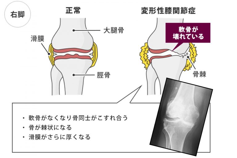 変形性膝関節症あなたの変形性膝関節症は、ヒアルロン酸注射で本当に改善していますか?