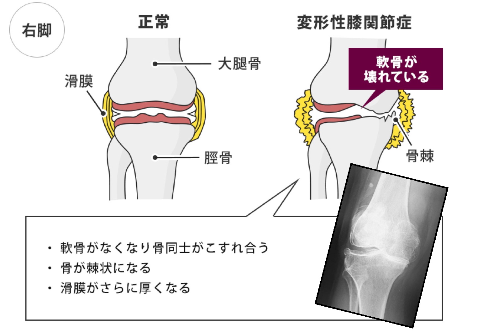 変形性膝関節症|ダエンからマル Lab.(ラボラトリー)|ダエンからマル施術院 変形性膝関節症|ダエンからマル Lab.(ラボラトリー)|ダエンからマル施術院