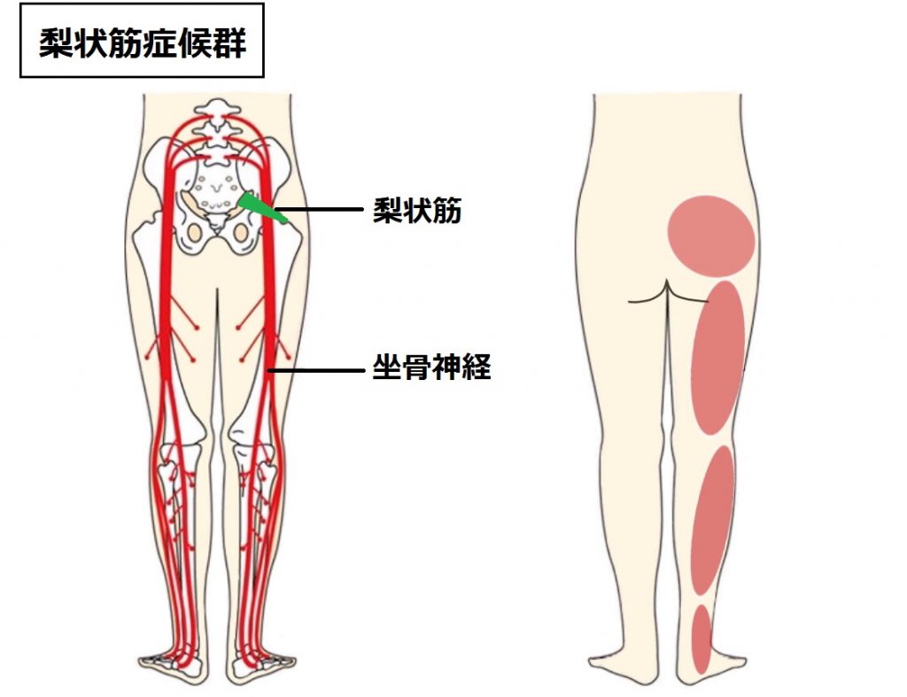 梨状筋症候群 坐骨神経痛 ダエンからマル Lab ラボラトリー ダエンからマル施術院