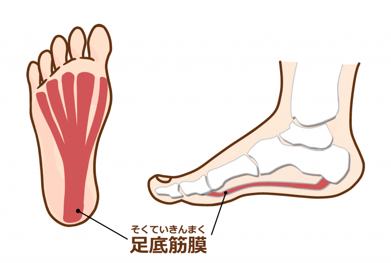 2年間治らない重度の足底筋膜炎が、2か月で再発なしに完治した話｜通院レポート｜ダエンからマル施術院